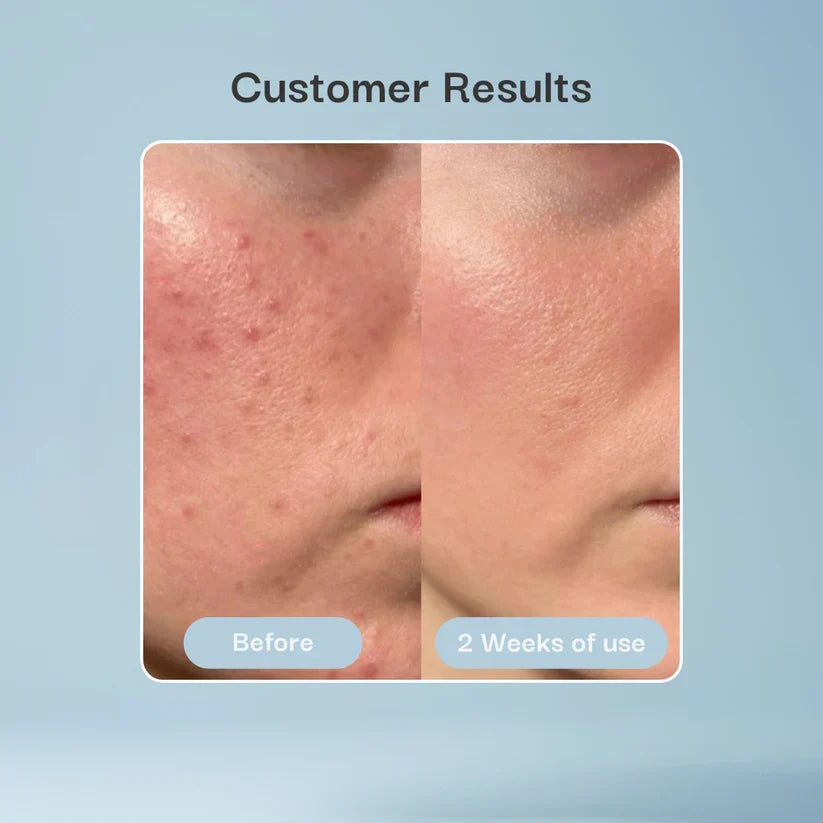Hydrocolloid Patch Bandages for Wound & Acne Care