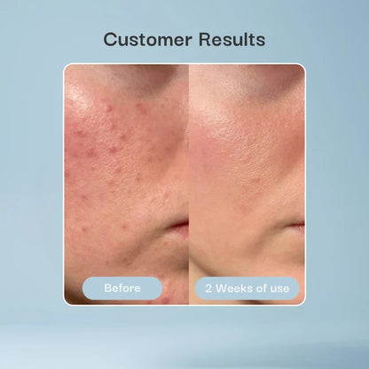 Hydrocolloid Patch Bandages for Wound & Acne Care
