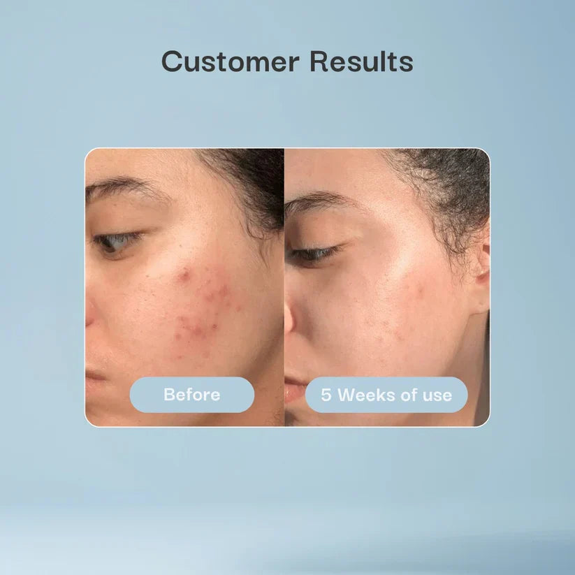 Hydrocolloid Patch Bandages for Wound & Acne Care