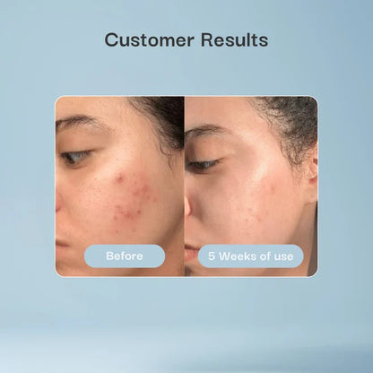 Hydrocolloid Patch Bandages for Wound & Acne Care