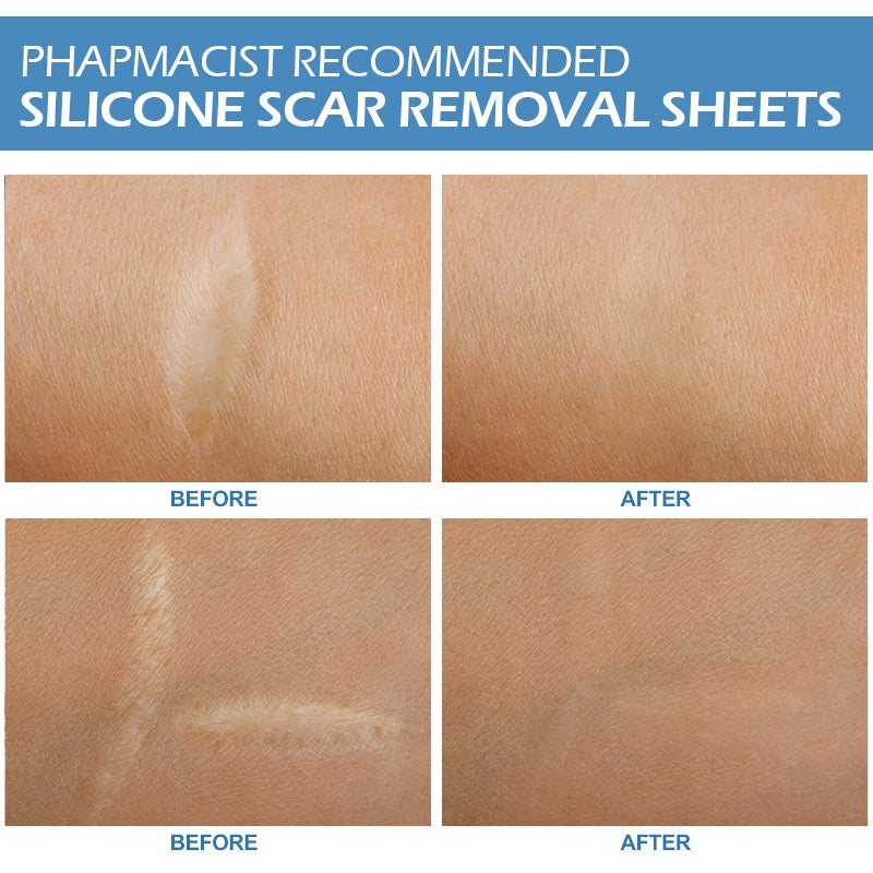 Silicone Gel Sheets for Scar