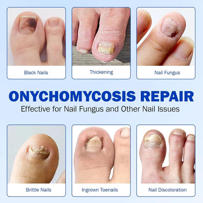 Nighttime Renewal Fungal Nail Treatment Patches