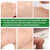 Pimple Patch: Hydrocolloid Acne Treatment