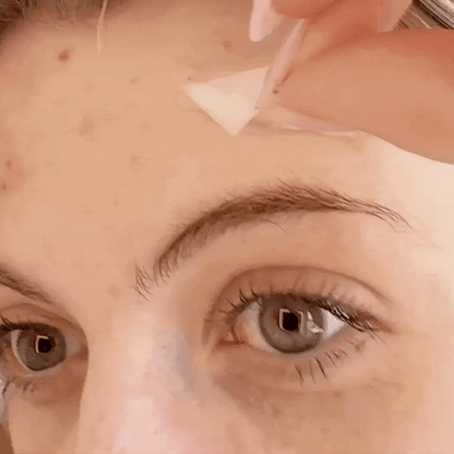 Hydrocolloid Patch Bandages for Wound & Acne Care
