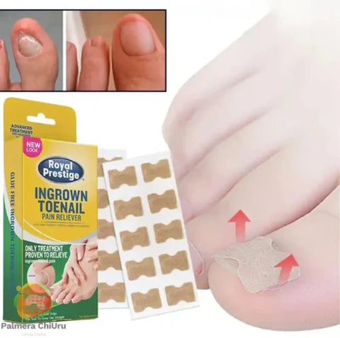 Ingrown Toenails and Fungal Infections